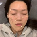 하얀나라 | 설날 연휴 맞이 점 제거 후기_하얀나라피부과_이벤트 가격으로 얼굴 점 정리했습니다