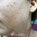 (주)레이바이오 디니힐링 30회 체험기 &#34;아토피가 많이 좋아졌어요&#34;