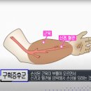 급성 구획증후군 후유증을 남기지 않으려면 이미지