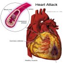 콜레스테롤 & 심장 (Cholesterol & The Heart) 이미지