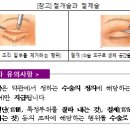 수술보험금은 약관상 정하는 수술 방법(절단·절제 등)에 해당하지 않으면 보험금을 지급받지 못할 수 있습니다. 이미지