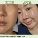 로스페이스 | [홍대피부과] 리쥬란힐러 맛집, 4cc 한방울도 놓치지마세요, 미세 니들을 이용한 약물로스 0% 후기