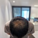 평택 탈모치료 소망의원 후기