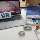 4월, 최민욱 원장님 본드필 세미나 후기(잇몸 패임, 치아 패임)