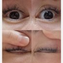 브라운아이의원 | 브라운아이의원 | 반영구 아이라인 문신 제거 후기