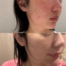 브이 | 잠실피부과 홍조피부관리 브이빔 솔직후기