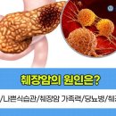생존율 17%, 췌장암 키우는 3가지 습관 이미지