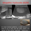 Idiopathic Hydrocele (60/M) 이미지