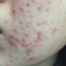 본약국 | 아젤리아크림 약국 가격 여드름에 효과본 후기