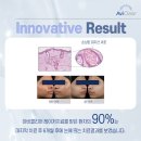 채영수피부과의원 | 여드름치료레이저후기 여드름의 재발률을 낮춰 높은 만족도를 나타내는 아비클리어