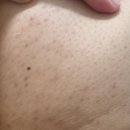 뉴 SK사우나 | 부산 연산동 수현에스테틱 색소침착+ 등드름 뉴알라딘필링