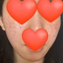 444 | [압구정] 루비레이저 주근깨 제거 444샷 내돈내산 14일 후기