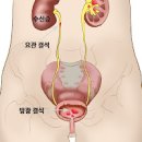 방광 결석 원인 진단 예방 방광결절 제거술 이미지