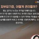 피부묘기증 원인 및 증상과 치료 이미지