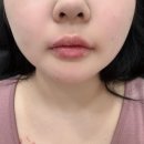 퓨어멍 | 기록 / 예신 피부과 시술 대방출~ / 예랑이 보톡스 추천 / 예신이 입술 필러 추천 / 메이퓨어 의원 후기