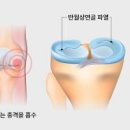 반월상 연골 파열 및 수술 (무릎 연골 찢어짐, 안쪽 통증) 이미지