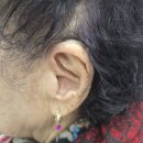 스타키보청기 | 전주벨톤보청기, 70대 어머니 스타키 제네시스 보청기 착용 후기