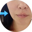 상상디자인365 | 땅콩형 얼굴 올리디아 볼륨 365 후기, 팔자·볼패임 변화와 통증