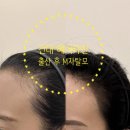 채운 | 건대 헤어라인 후기 전해드려요｜군자 헤어라인 자연스럽게 채운 리얼 후기
