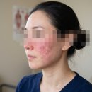 안면가스 - 17890 | 대구안면홍조 치료 레이저로 붉은기 잡은 후기