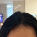 욜로유통 | 두피앰플 추천 듀크레이 네옵타이드 엑스퍼트 두피케어 루틴 후기