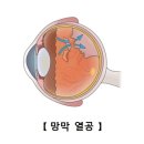 망막 열공(retina tear) 눈 질환이란? 이미지