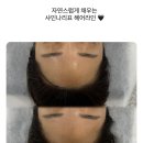 해운대헤어라인반영구 로 자신감 회복! 샤인나리