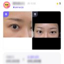 앤드성형외과의원 | 무쌍 짝눈 자연유착 눈매교정 트임 앤드성형외과 수술후기