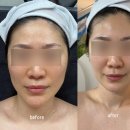76 | 산본에스테틱 에코 군포피부관리샵 다운타임 없는 윤곽관리 효과 대대만족 후기