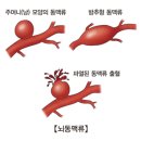 뇌동맥류 (Cerebral aneurysm) 이미지