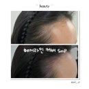 커버닷 | 헤어라인 커버 SMP 만족 후기｜합정 루문(LUMOON)
