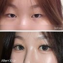 체인지의원 | 수험생 눈성형, 졸업 전 이미지 체인지🔥 강남 이벤트 정보!