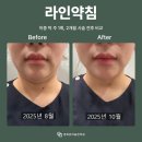 온마음한의원 | 양주 다이어트 한의원 군살정리엔 라인약침