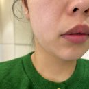 웨이브필 | 이중턱관리 울쎄라100샷/엑셀웨이브/지방분해주사. 지방분해와 재생을 동시에 받은 찐 내돈내산 후기.