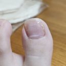 바른네일레푸스 | 바른네일 레푸스 수원시청점 - 임산부 내성발톱 교정(2달) 후기