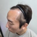 응달말로 | 구리두피문신 다닷SMP 내돈내산 2회차 전체숱채움 진행 만족 후기
