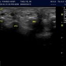 morton's neuroma of foot 이미지