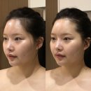 라인에스테틱 - 천안시 동남구 | 광주온다 페이스 관리 받고 3일 후 달라진 얼굴 라인, '오월에스테틱' 후기