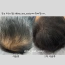 정혜경헤어 | #지축두피문신전문 #지축두피문신후기#지축두피탈모커버 - 남자 정수리 커버도 역시 디앤드스칼프에서...