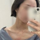 퍼플의원 | 안양 편평사마귀 무제한 제거 후기 듀오덤 없음/ 내돈내산