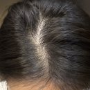 헤어로의원 | 내돈내산 강남 헤어온의원 후기