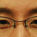 닥터윤성형외과의원 | 닥터홍 성형외과 눈썹이식 후기, 동생의 1년 후 달라진 인상