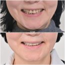 100세 치과의원 | 60대 인비절라인 익스프레스 벌어진 틈 치주 노년 교정 블랙트라이앵글 레진 수복 치료기간 11...