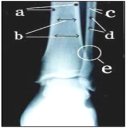 상박골 | 골수염 Osteomyelitis