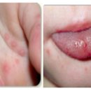 2014어린이집 방문간호사 서비스(수족구병 발생예방)가정통신문 이미지