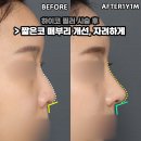 하이코코 | 필러 하이코 시술받았지만 부족한 효과로 코성형 선택 전후 후기