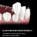 네츄럴치과기공소 네이버블로그