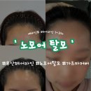 다함헤어&뷰티 | W.09 부산 예비신부 헤어라인 3회차 고민해결 • 부산 노모어탈모 • 예신뷰티관리