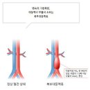 터지면 70% 사망! 뱃속의 시한폭탄 '복부대동맥류' 예방수칙﻿ 이미지