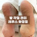 레푸스 화정점 | 소중한 발을 위한 전문 케어 레푸스 화정점 찐 후 기